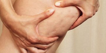 Celulita, o problema? Scapa de ea