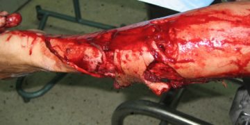 Imagini socante! Un barbat a fost zdrobit de un caine